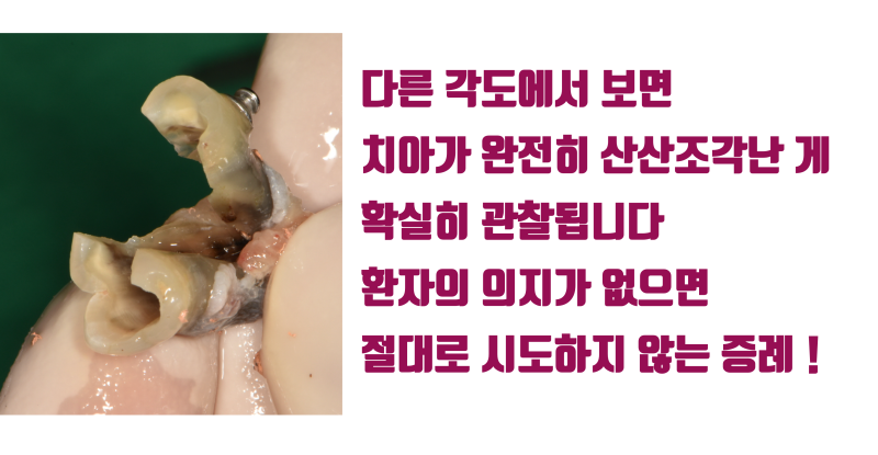 [가슴 벅찬 치아살리기] 완전히 쪼개진 치아를 살렸다! #재식술 #치아재식술 #최용훈원장 사진 3