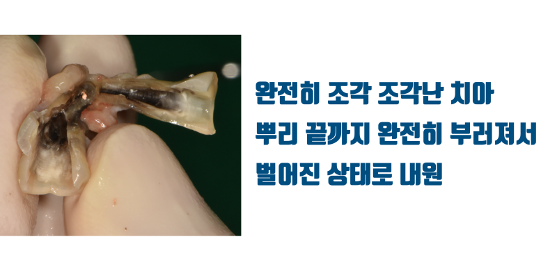 [가슴 벅찬 치아살리기] 완전히 쪼개진 치아를 살렸다! #재식술 #치아재식술 #최용훈원장 사진 2