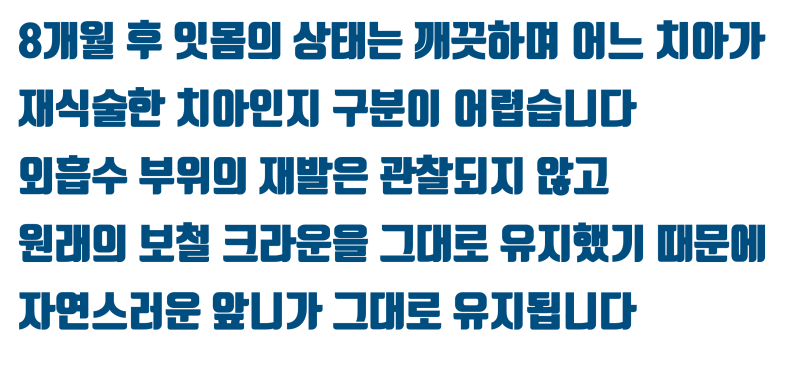 [심장 멎음 주의] 안 부러지는게 이상한 치아, 뿌리가 녹아버린 치아를 살리고 보철까지 살린 경우 #재식술 #치아재식술 #최용훈원장 사진 7