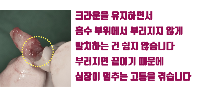 [심장 멎음 주의] 안 부러지는게 이상한 치아, 뿌리가 녹아버린 치아를 살리고 보철까지 살린 경우 #재식술 #치아재식술 #최용훈원장 사진 3