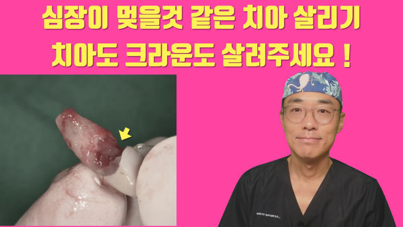 [심장 멎음 주의] 안 부러지는게 이상한 치아, 뿌리가 녹아버린 치아를 살리고 보철까지 살린 경우 #재식술 #치아재식술 #최용훈원장