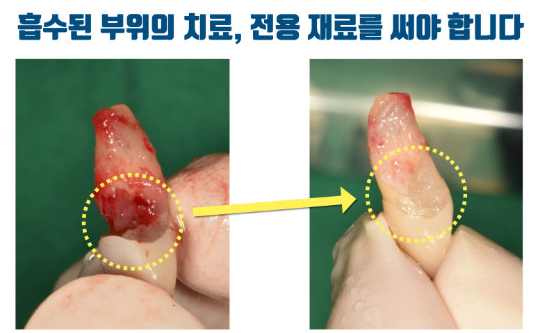 [심장 멎음 주의] 안 부러지는게 이상한 치아, 뿌리가 녹아버린 치아를 살리고 보철까지 살린 경우 #재식술 #치아재식술 #최용훈원장 사진 4