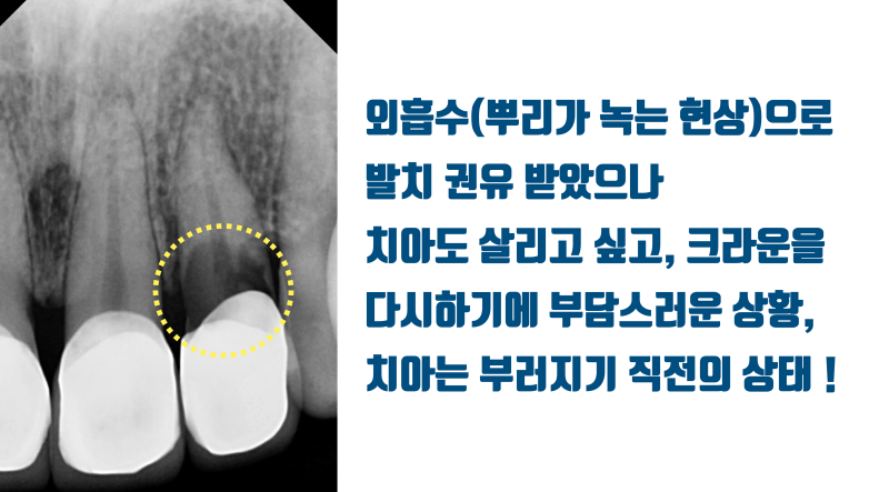 [심장 멎음 주의] 안 부러지는게 이상한 치아, 뿌리가 녹아버린 치아를 살리고 보철까지 살린 경우 #재식술 #치아재식술 #최용훈원장 사진 2