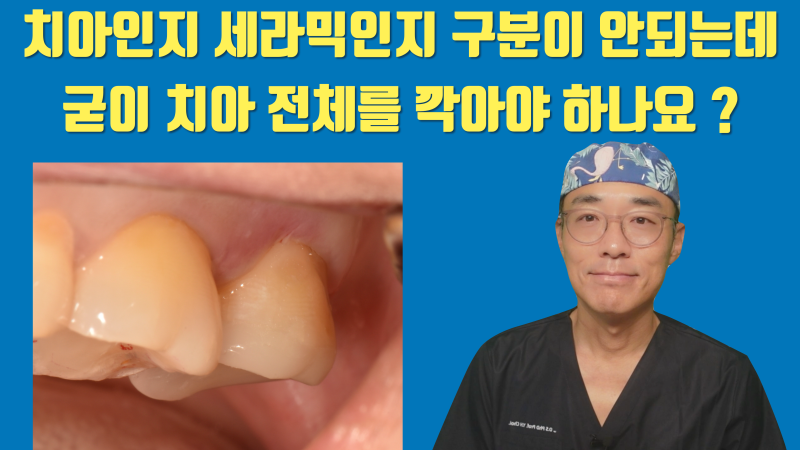[소신 발언] 보이지도 않는 어금니에 굳이 치아를 많이 깍아서 크라운을 해야 할까요 ? #치아살리기 #최용훈원장
