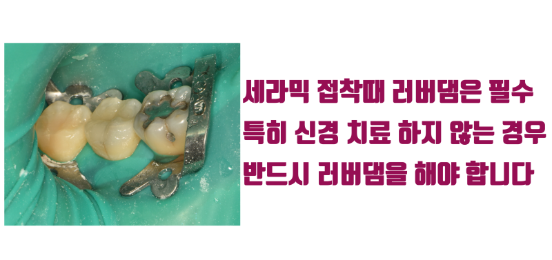 [소신 발언] 보이지도 않는 어금니에 굳이 치아를 많이 깍아서 크라운을 해야 할까요 ? #치아살리기 #최용훈원장 사진 3