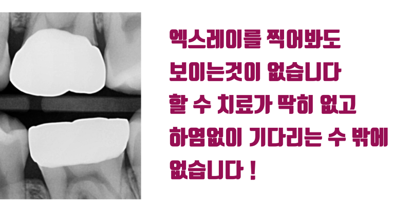 [안타까운 환자 이야기] 하지 말라고 한 치료를 받은 환자가 겪고 있는 고통 #치아살리기 #최용훈원장 사진 4