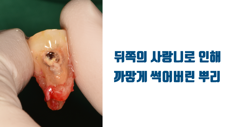 [오랜 숙원의 해결] 이 방법을 알았다면 40년을 고생하지는 않았을 건데... #재식술 #치아살리기 #최용훈원장