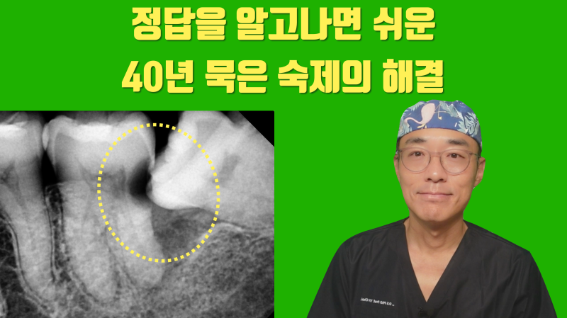 [오랜 숙원의 해결] 이 방법을 알았다면 40년을 고생하지는 않았을 건데... #재식술 #치아살리기 #최용훈원장