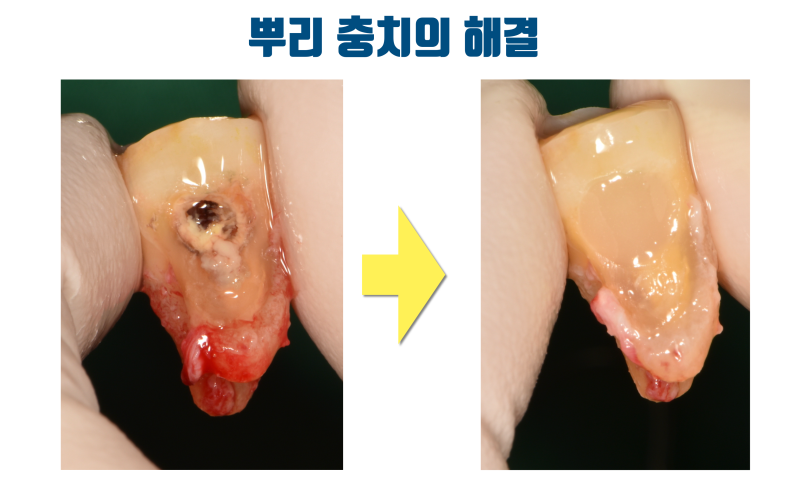 [오랜 숙원의 해결] 이 방법을 알았다면 40년을 고생하지는 않았을 건데... #재식술 #치아살리기 #최용훈원장 사진 3