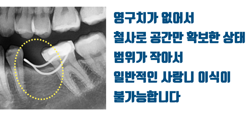 [부모님의 선물] 선천적으로 영구치가 없는 자리에 사랑니 이식으로 새 자연 치아가 생겼다 ~! #치아이식 #사랑니이식 #최용훈원장 사진 2