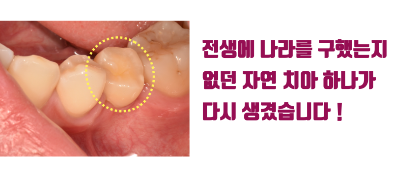 [부모님의 선물] 선천적으로 영구치가 없는 자리에 사랑니 이식으로 새 자연 치아가 생겼다 ~! #치아이식 #사랑니이식 #최용훈원장 사진 6