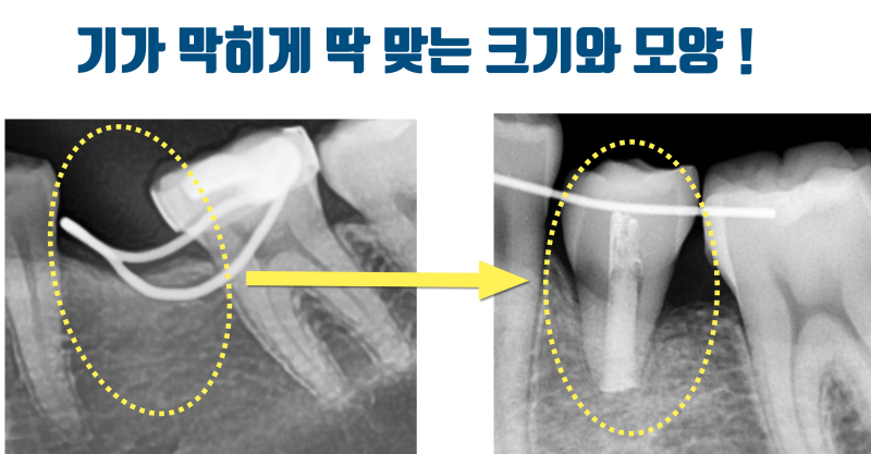 [부모님의 선물] 선천적으로 영구치가 없는 자리에 사랑니 이식으로 새 자연 치아가 생겼다 ~! #치아이식 #사랑니이식 #최용훈원장