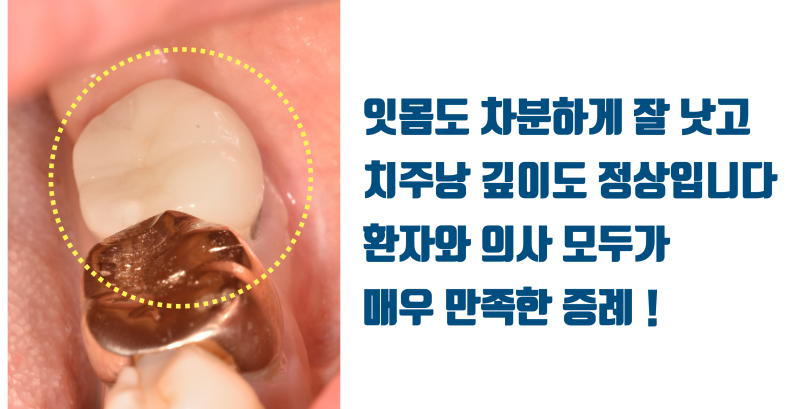 [X친 치과 치료] 재식술 실패 + 완전 파절 치아의 치아 살리기, 집요한 환자와 의사가 만났다 #재식술 #파절치아 #최용훈원장 사진 6