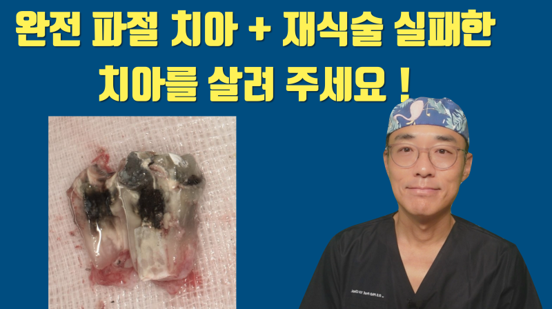 [X친 치과 치료] 재식술 실패 + 완전 파절 치아의 치아 살리기, 집요한 환자와 의사가 만났다 #재식술 #파절치아 #최용훈원장