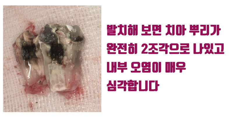 [X친 치과 치료] 재식술 실패 + 완전 파절 치아의 치아 살리기, 집요한 환자와 의사가 만났다 #재식술 #파절치아 #최용훈원장 사진 3
