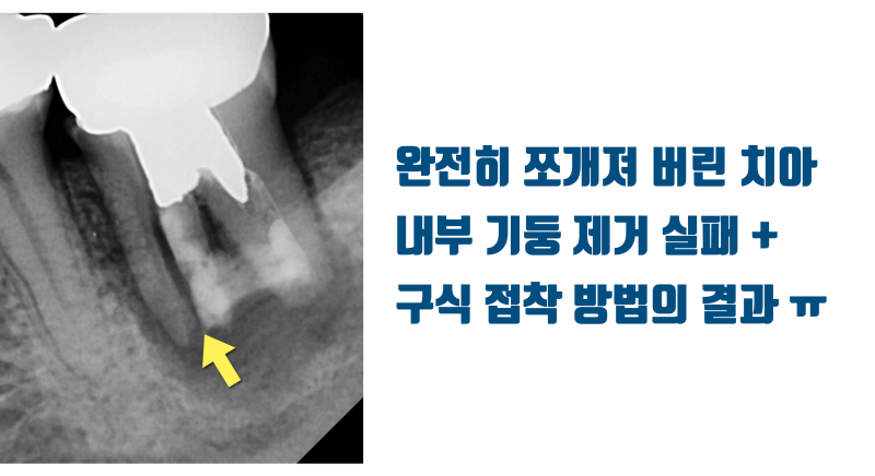 [X친 치과 치료] 재식술 실패 + 완전 파절 치아의 치아 살리기, 집요한 환자와 의사가 만났다 #재식술 #파절치아 #최용훈원장 사진 2