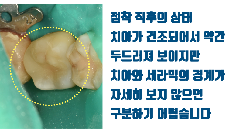 [예쁘게 안 아프게] 안 보이는 어금니를 굳이 예쁘게 치료하는 이유 #치아살리기 #최용훈원장