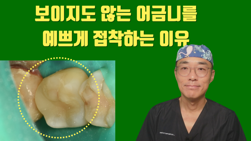 [예쁘게 안 아프게] 안 보이는 어금니를 굳이 예쁘게 치료하는 이유 #치아살리기 #최용훈원장