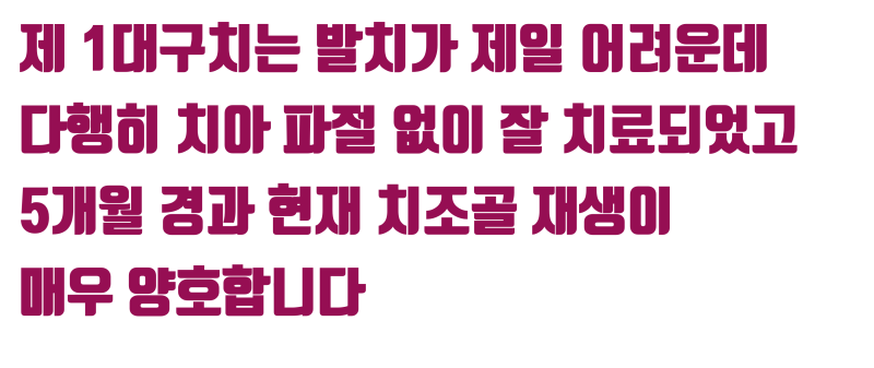 [판교에서 살린 치아] 재신경 치료 포기한 제 1대구치를 살려주세요 #재식술 #치아재식술 #최용훈원장 사진 6
