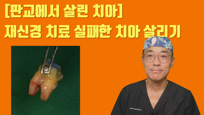 [판교에서 살린 치아] 재신경 치료 포기한 제 1대구치를 살려주세요 #재식술 #치아재식술 #최용훈원장