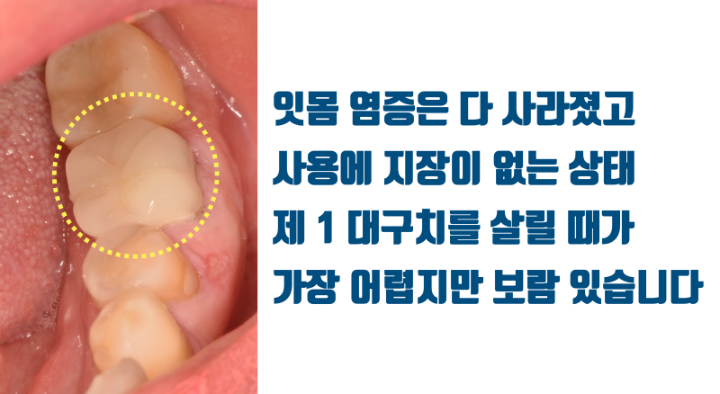 [판교에서 살린 치아] 재신경 치료 포기한 제 1대구치를 살려주세요 #재식술 #치아재식술 #최용훈원장 사진 7