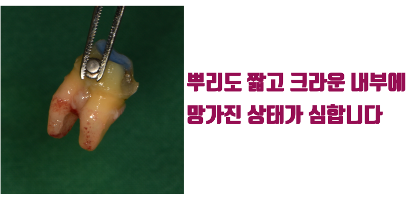 [판교에서 살린 치아] 재신경 치료 포기한 제 1대구치를 살려주세요 #재식술 #치아재식술 #최용훈원장 사진 3