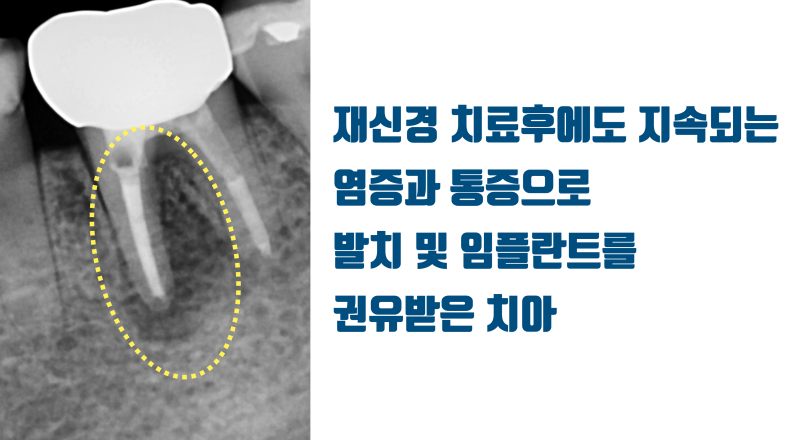 [판교에서 살린 치아] 재신경 치료 포기한 제 1대구치를 살려주세요 #재식술 #치아재식술 #최용훈원장 사진 2