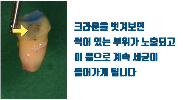 [판교에서 살린 치아] 재신경 치료 포기한 제 1대구치를 살려주세요 #재식술 #치아재식술 #최용훈원장 사진 4