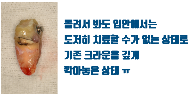 [안타까운 치아들] 기존 크라운이 너무 커서 어쩔 수 없이 재식술을 해야 하는 치아들 #재식술 #치아재식술 #최용훈원장 사진 4