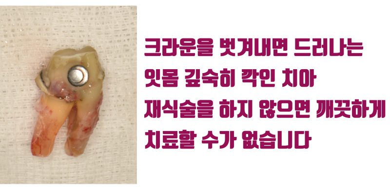 [안타까운 치아들] 기존 크라운이 너무 커서 어쩔 수 없이 재식술을 해야 하는 치아들 #재식술 #치아재식술 #최용훈원장 사진 3