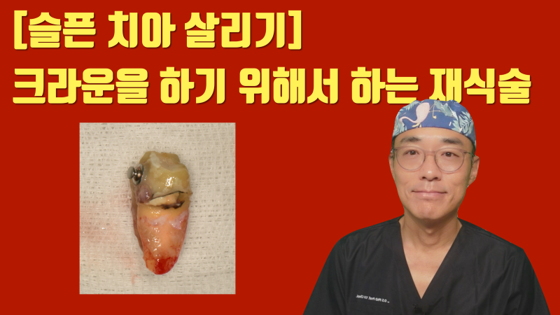 [안타까운 치아들] 기존 크라운이 너무 커서 어쩔 수 없이 재식술을 해야 하는 치아들 #재식술 #치아재식술 #최용훈원장