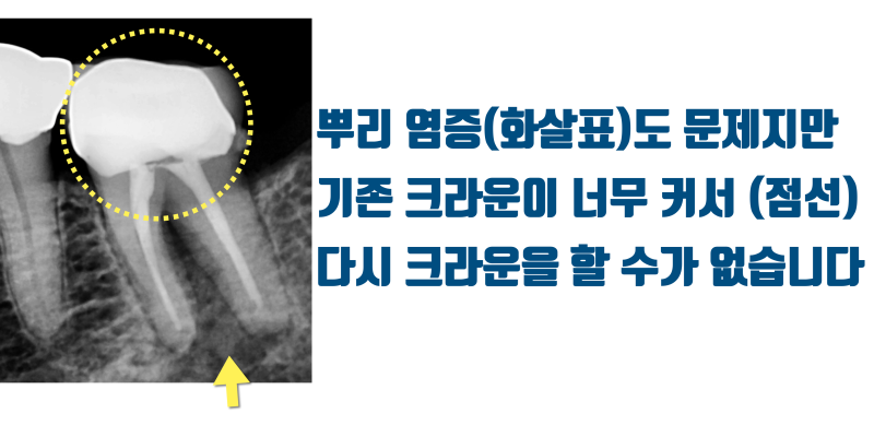 [안타까운 치아들] 기존 크라운이 너무 커서 어쩔 수 없이 재식술을 해야 하는 치아들 #재식술 #치아재식술 #최용훈원장 사진 2