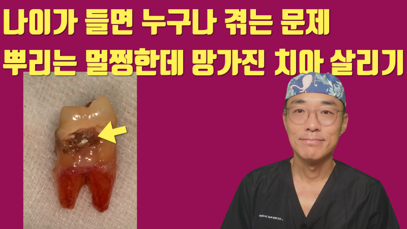 [고령 치아의 문제] 나이가 들면 누구나 겪는 뿌리 충치, 발치하기에는 너무 아까운 치아 이야기 #재식술 #치아재식술 #최용훈원장