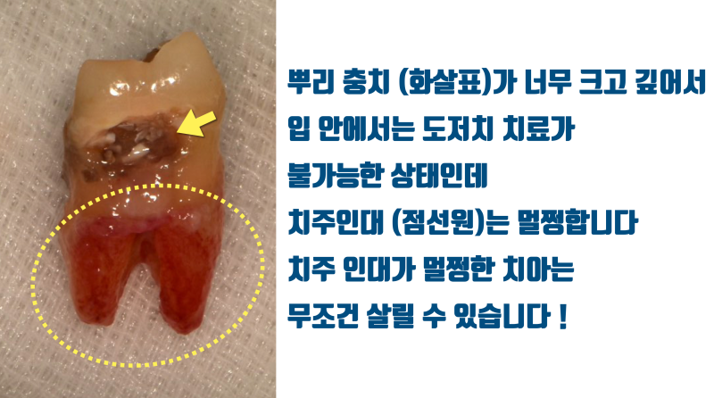 [고령 치아의 문제] 나이가 들면 누구나 겪는 뿌리 충치, 발치하기에는 너무 아까운 치아 이야기 #재식술 #치아재식술 #최용훈원장