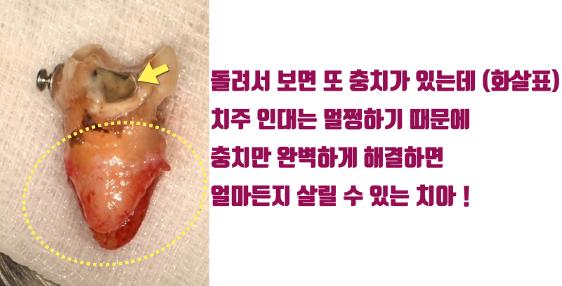 [고령 치아의 문제] 나이가 들면 누구나 겪는 뿌리 충치, 발치하기에는 너무 아까운 치아 이야기 #재식술 #치아재식술 #최용훈원장 사진 3