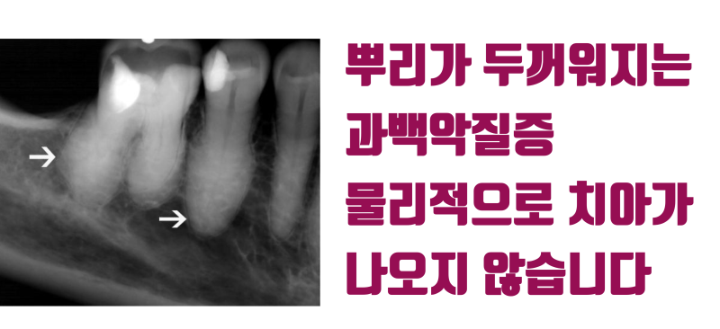 [불가능을 가능하게] 치아를 잡으면 무조건 부서지는 치아 + 뿌리 형태 이상으로 빠지지 않는 치아를 살리는 방법 #재식술 #치아재식술 #최용훈원장 사진 2