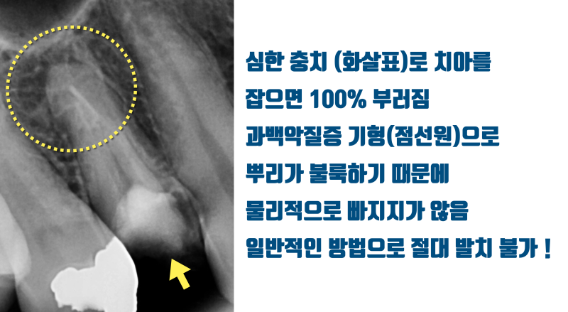 [불가능을 가능하게] 치아를 잡으면 무조건 부서지는 치아 + 뿌리 형태 이상으로 빠지지 않는 치아를 살리는 방법 #재식술 #치아재식술 #최용훈원장
