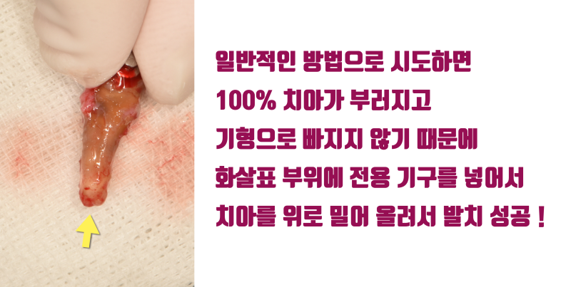[불가능을 가능하게] 치아를 잡으면 무조건 부서지는 치아 + 뿌리 형태 이상으로 빠지지 않는 치아를 살리는 방법 #재식술 #치아재식술 #최용훈원장 사진 4