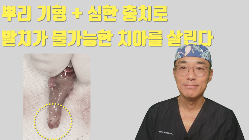 [불가능을 가능하게] 치아를 잡으면 무조건 부서지는 치아 + 뿌리 형태 이상으로 빠지지 않는 치아를 살리는 방법 #재식술 #치아재식술 #최용훈원장