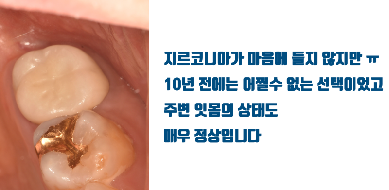 [재식술 10년 성공 사례] 뿌리 3개인 어금니의 10년 성공적인 재식술 #재식술 #치아재식술 #최용훈원장 사진 4