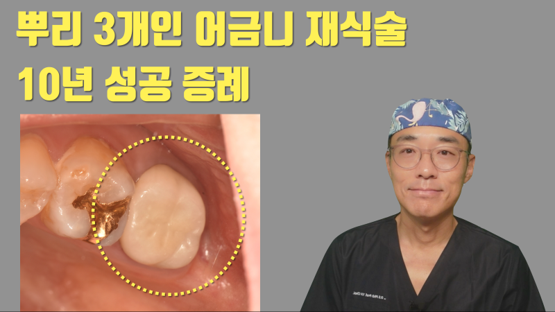 [재식술 10년 성공 사례] 뿌리 3개인 어금니의 10년 성공적인 재식술 #재식술 #치아재식술 #최용훈원장