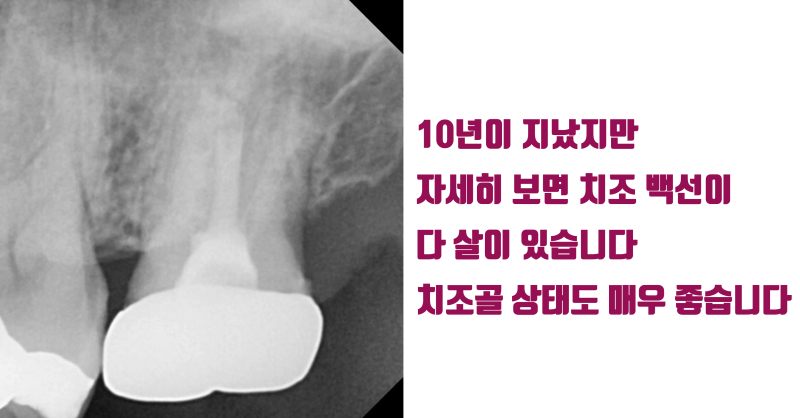 [재식술 10년 성공 사례] 뿌리 3개인 어금니의 10년 성공적인 재식술 #재식술 #치아재식술 #최용훈원장
