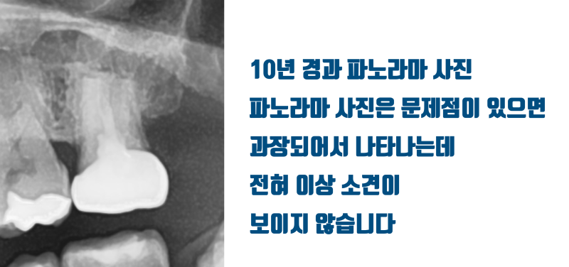 [재식술 10년 성공 사례] 뿌리 3개인 어금니의 10년 성공적인 재식술 #재식술 #치아재식술 #최용훈원장 사진 2
