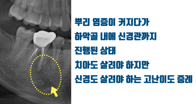 [할거면 제대로, 치근단 수술] 신경관까지 번진 염증의 치근단수술(치근절제술) 해결 5년 증례 #치근단수술 #치근절제술 #최용훈원장 사진 2