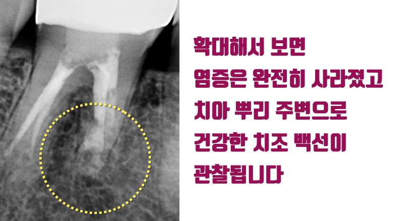 [할거면 제대로, 치근단 수술] 신경관까지 번진 염증의 치근단수술(치근절제술) 해결 5년 증례 #치근단수술 #치근절제술 #최용훈원장