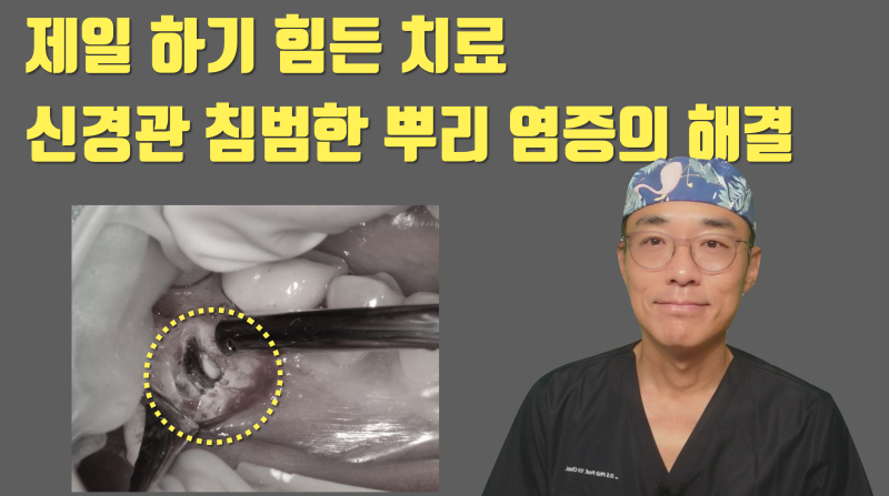 [할거면 제대로, 치근단 수술] 신경관까지 번진 염증의 치근단수술(치근절제술) 해결 5년 증례 #치근단수술 #치근절제술 #최용훈원장