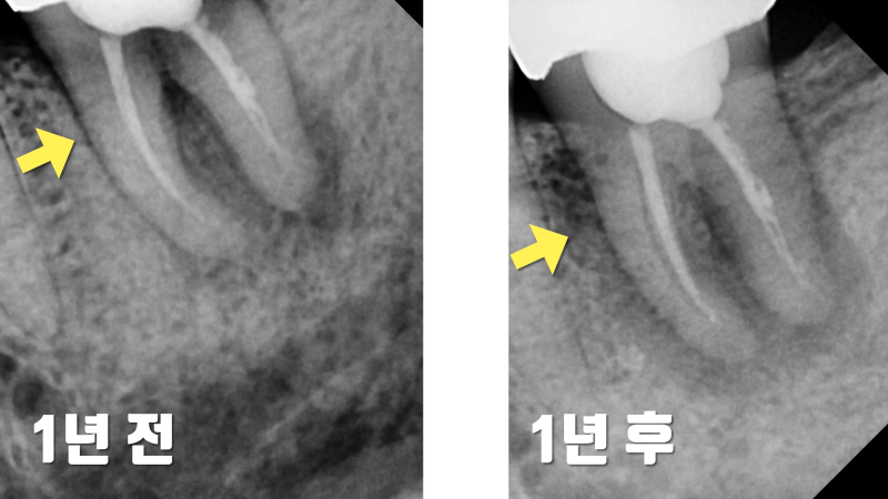 [치료 시기의 중요성] 재식술 치료 타이밍을 놓친 환자의 비극 #재식술 #치아재식술 #최용훈원장