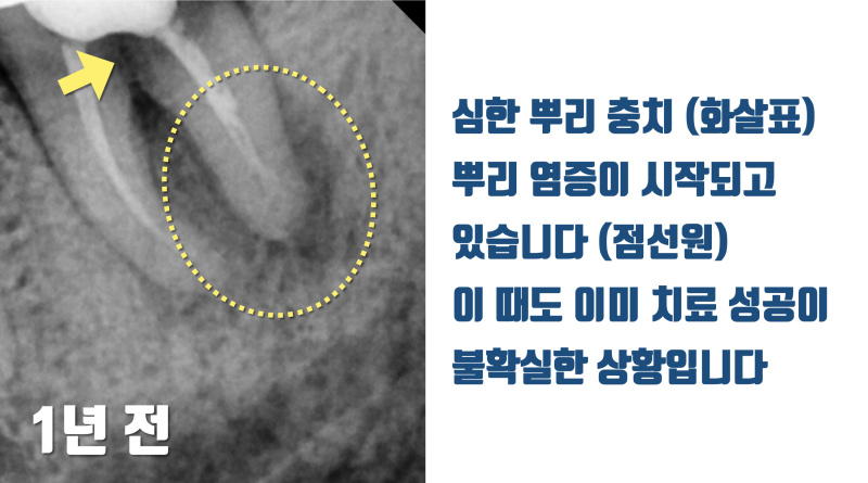 [치료 시기의 중요성] 재식술 치료 타이밍을 놓친 환자의 비극 #재식술 #치아재식술 #최용훈원장 사진 2
