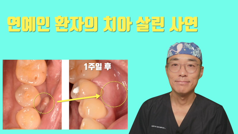 [연예인 환자 치료 후기] 오랫동안 방치된 치아 염증의 1주일만에 해결 #치아살리기 #플라젠 #최용훈원장
