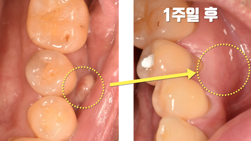 [연예인 환자 치료 후기] 오랫동안 방치된 치아 염증의 1주일만에 해결 #치아살리기 #플라젠 #최용훈원장